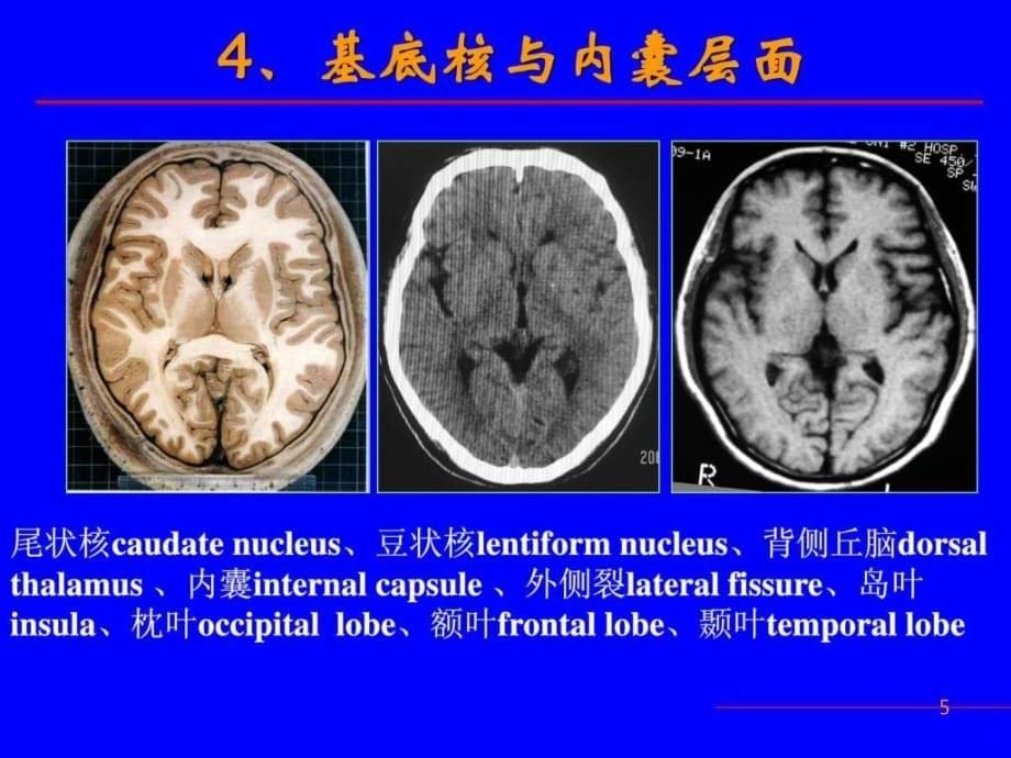 精品推荐医学影像诊断课件图文详解完整版-神经系统ppt课件_第5页