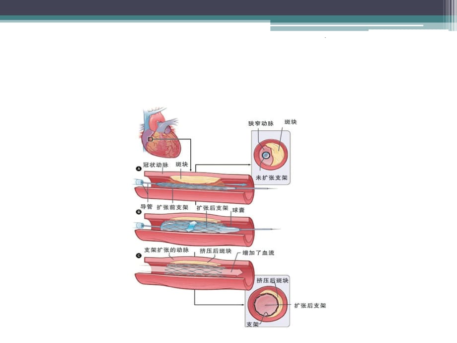 冠脉内溶栓临床应用ppt精选课件_第3页