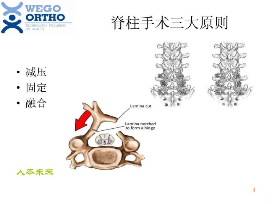 脊柱内固定原理PPT课件_第4页