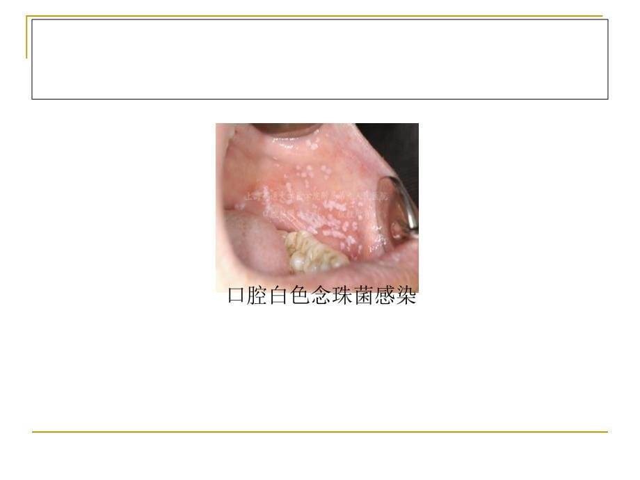 深部真菌感染及治疗药物.ppt_第5页