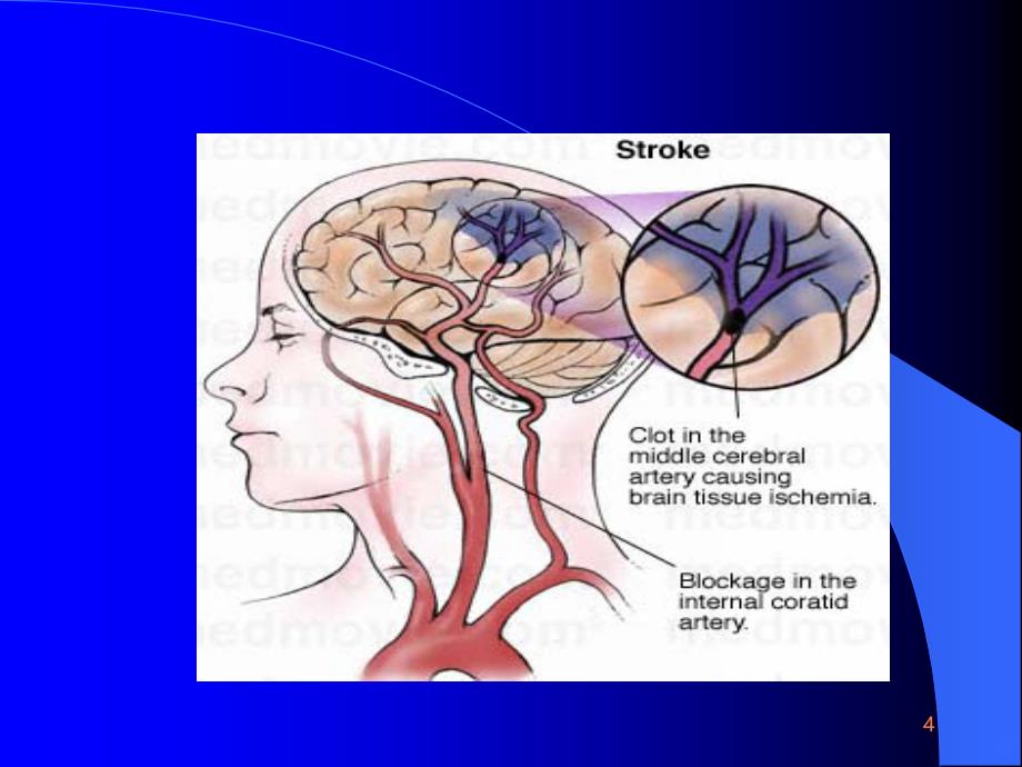 急性脑血管疾病危险因素及防治ppt课件_第4页