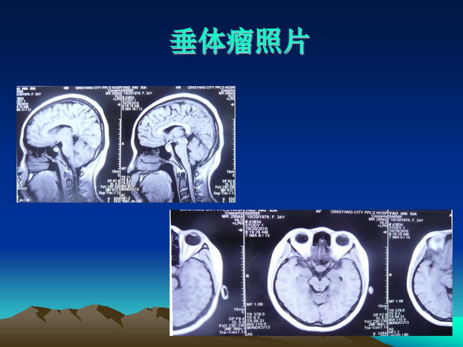 垂体瘤术后查房护理.ppt_第4页