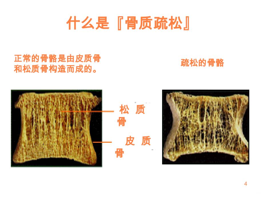 老年骨质疏松症的护理ppt课件_第4页