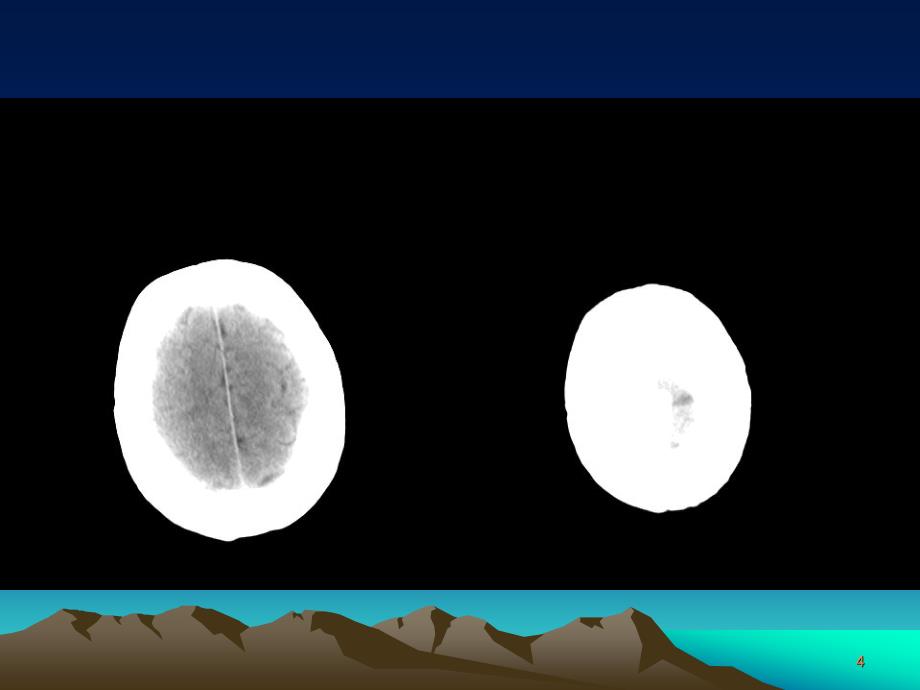 颅内占位病变PPT课件_第4页