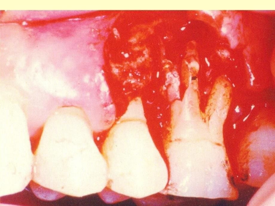 牙周炎的伴发疾病牙周脓肿对全身疾病的影响幻灯片资料_第5页