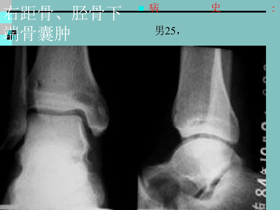 《右腓骨下端骨囊肿》PPT课件ppt课件_第2页