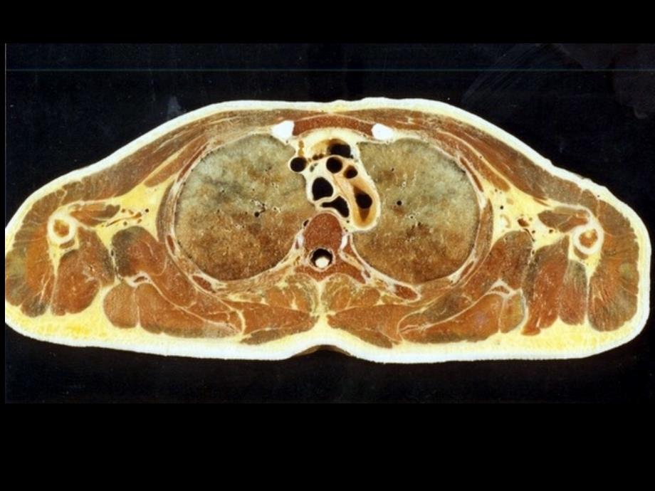 纵隔连续横断层解剖及CT知识分享_第4页