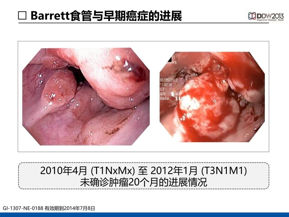 食管癌的内镜治疗从消融到切除的进展ppt课件_第3页