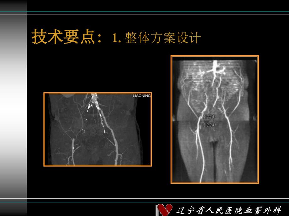 运用之妙存乎一心浅谈主髂动脉闭塞腔内治疗技术要点教学讲义_第3页