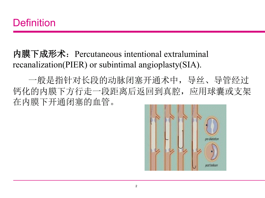 内膜下成形术治疗下肢动脉硬化闭塞ppt课件_第2页