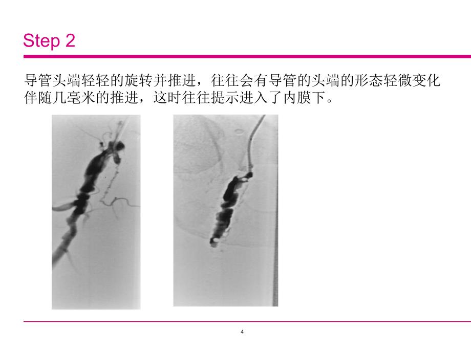 内膜下成形术治疗下肢动脉硬化闭塞ppt课件_第4页