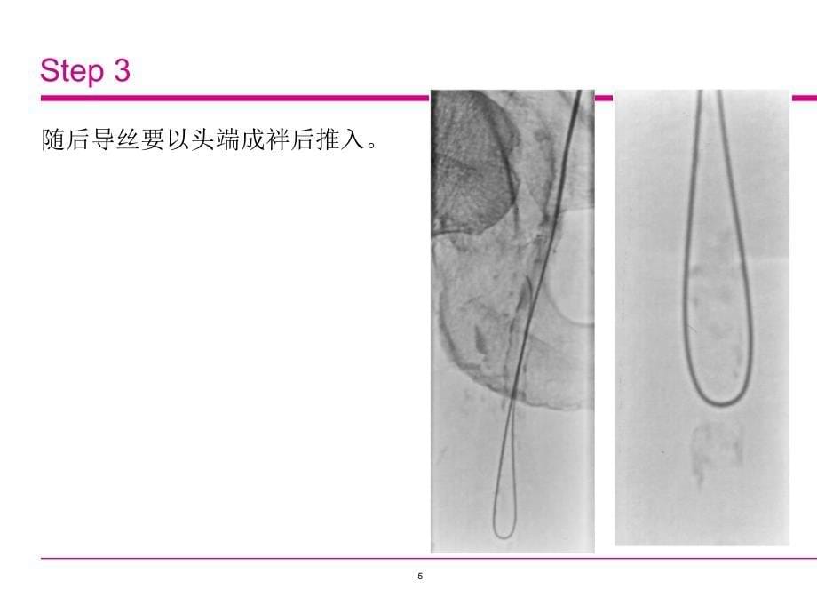 内膜下成形术治疗下肢动脉硬化闭塞ppt课件_第5页