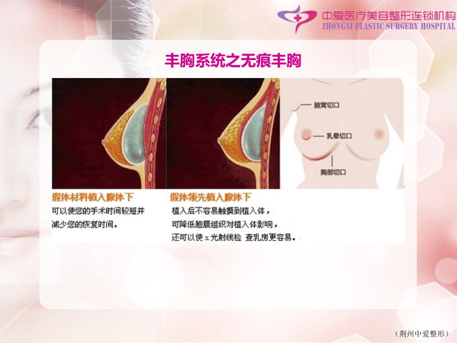 丰胸整形PPT课件_第4页