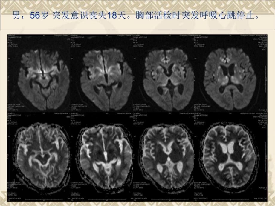 总结DWI在颅脑疾病诊断中的应用 (中)幻灯片资料_第5页