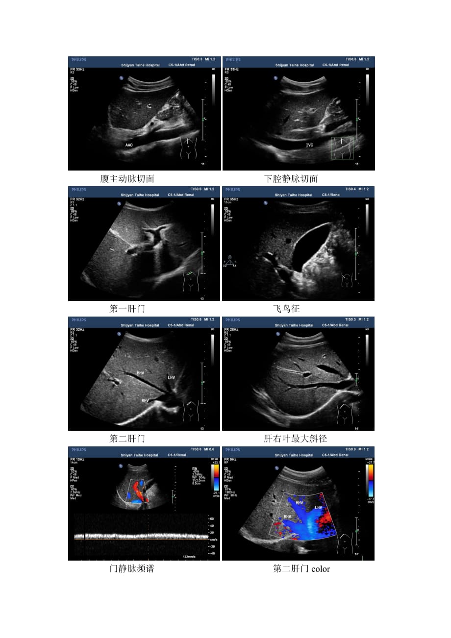 肝脏超声标准切面图示.doc_第1页