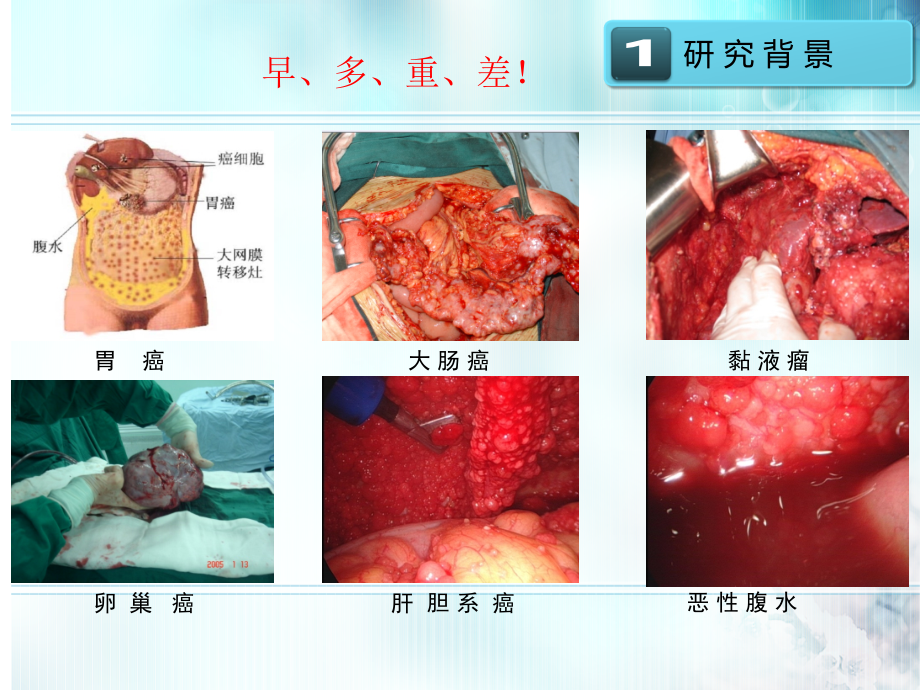 腹腔热灌注新进展上课讲义_第4页