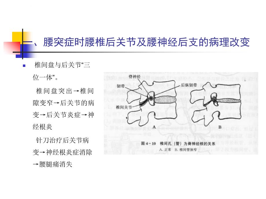 针刀治疗腰椎间盘突出课件_第4页