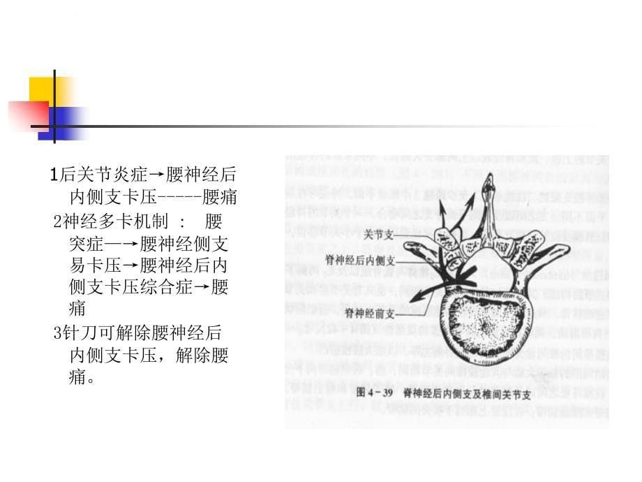 针刀治疗腰椎间盘突出课件_第5页