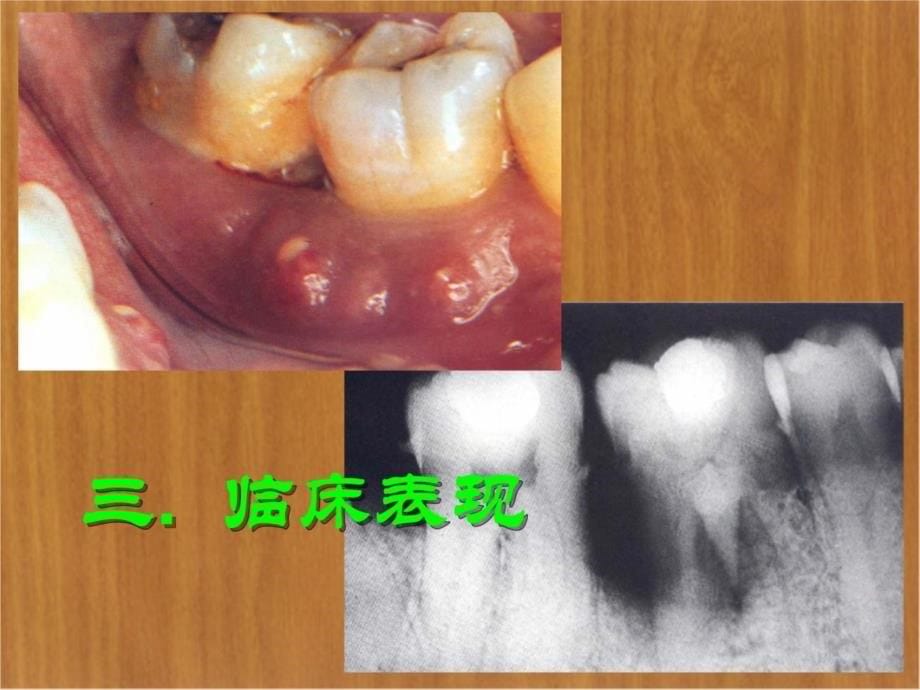 十一章牙周炎伴发病变讲课资料_第5页