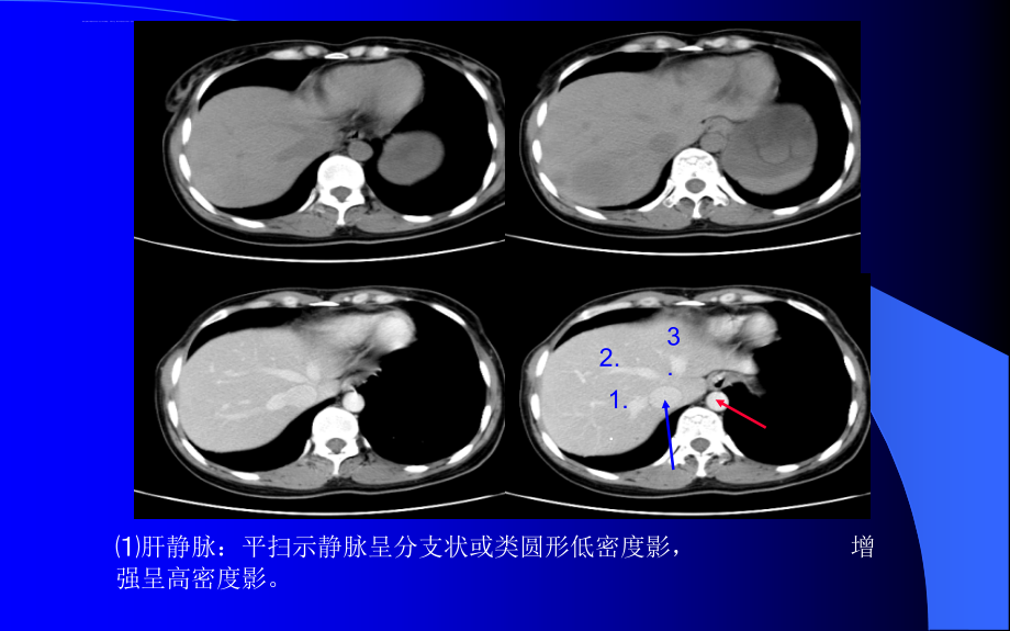 腹部CT解剖及诊断(速成)课件_第4页