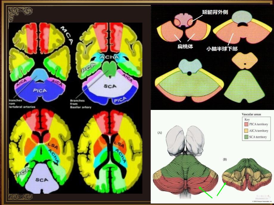 脑血管解剖及脑梗塞定位诊断-小脑后下动脉课件_第3页