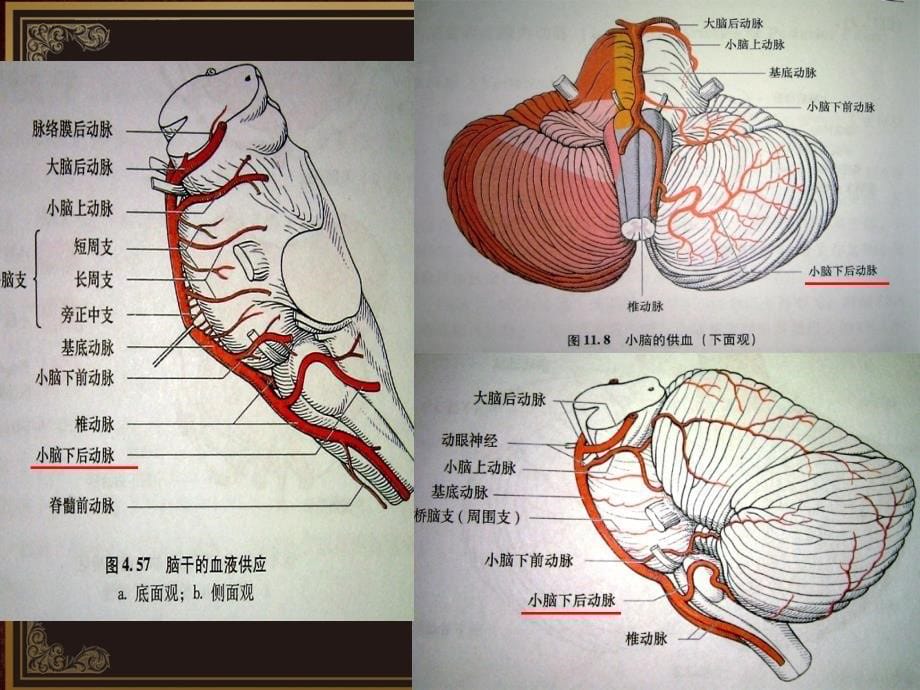 脑血管解剖及脑梗塞定位诊断-小脑后下动脉课件_第5页