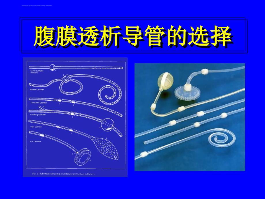 腹膜透析置管术课件_第2页