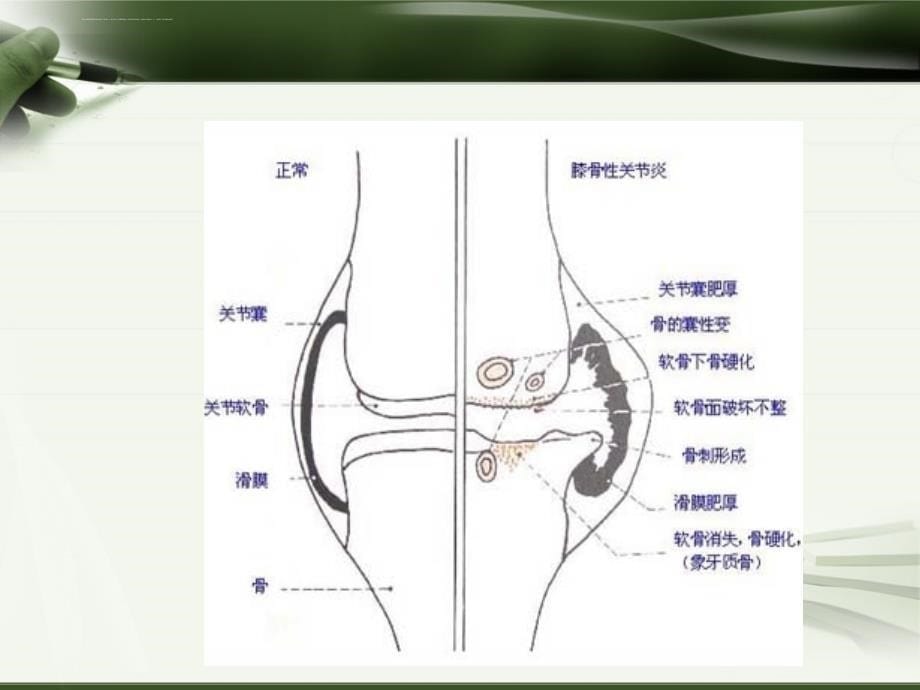 针刀治疗膝关节骨性关节炎课件_第5页