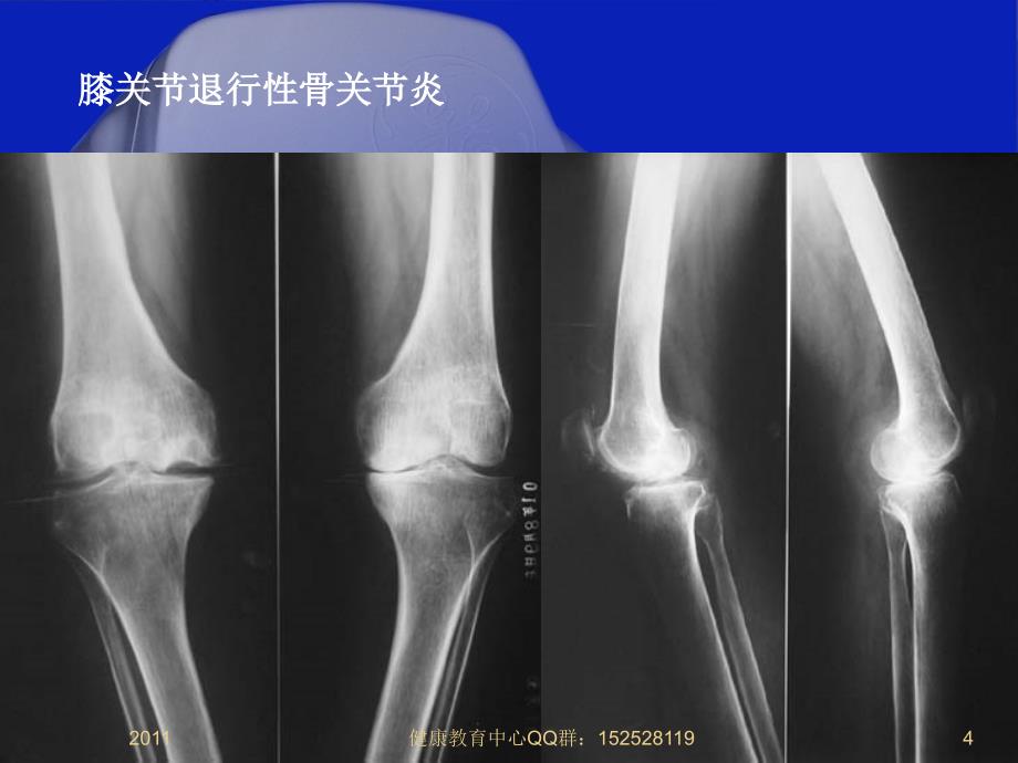 潘良春2《骨关节炎的家庭防治》教学材料_第4页