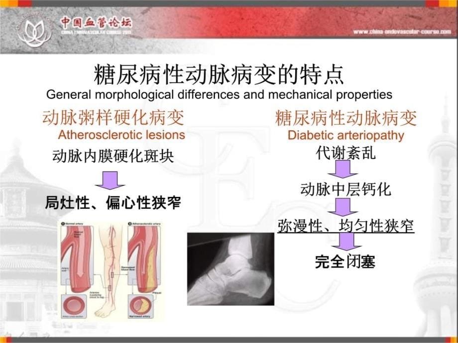 缺血糖尿病足CTO病变特点和治疗技术课件资料讲解_第5页