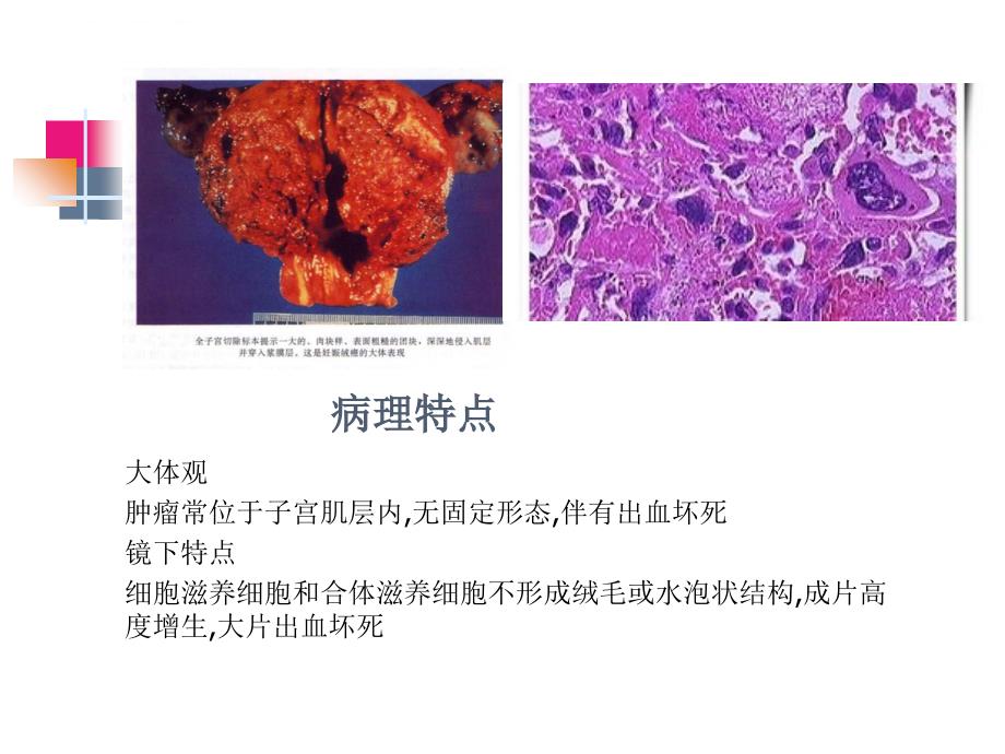 绒癌护理查房课件_第3页