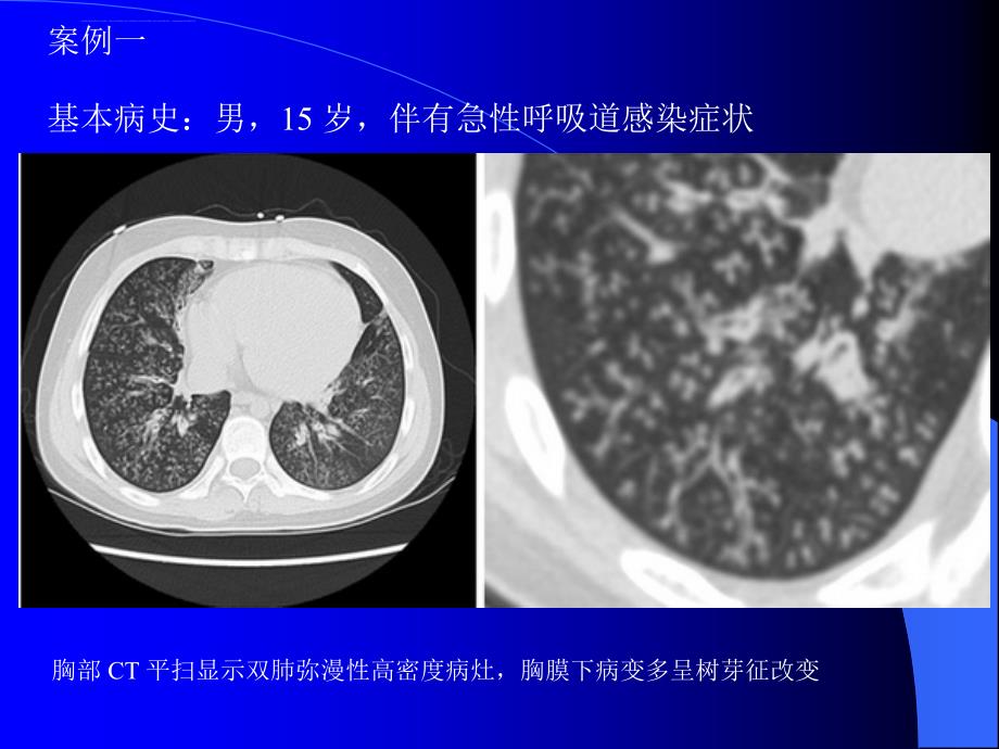肺部CT十大征象诊断应用课件_第3页