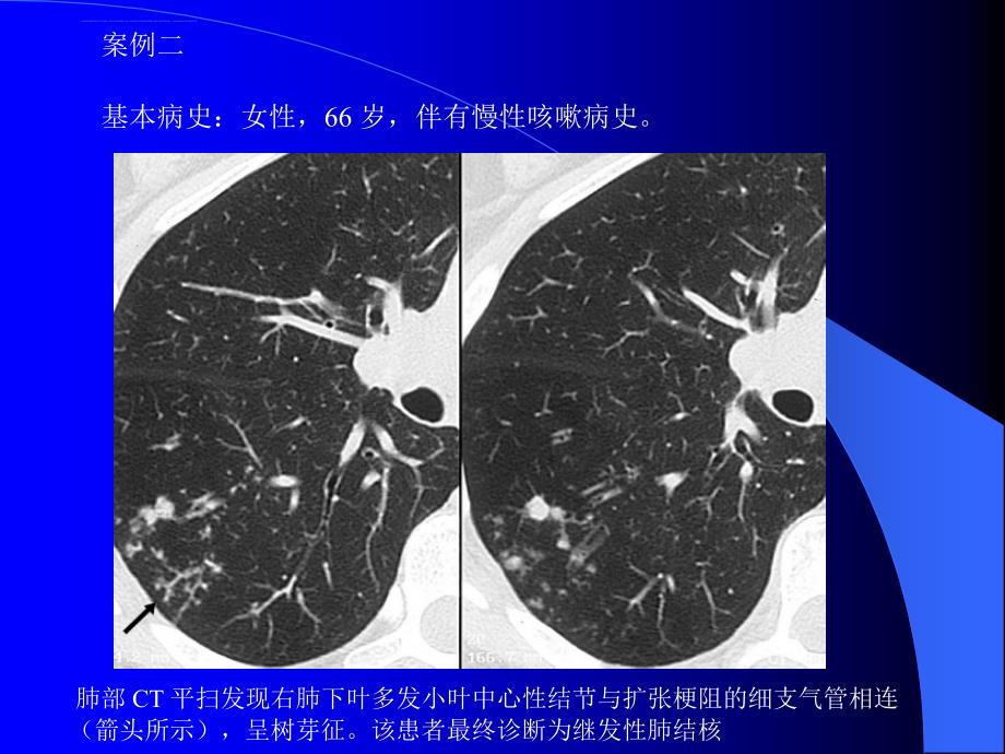 肺部CT十大征象诊断应用课件_第4页