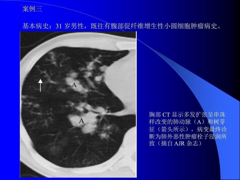 肺部CT十大征象诊断应用课件_第5页