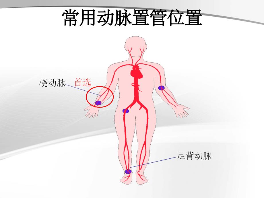 动脉穿刺置管术最新版本_第4页