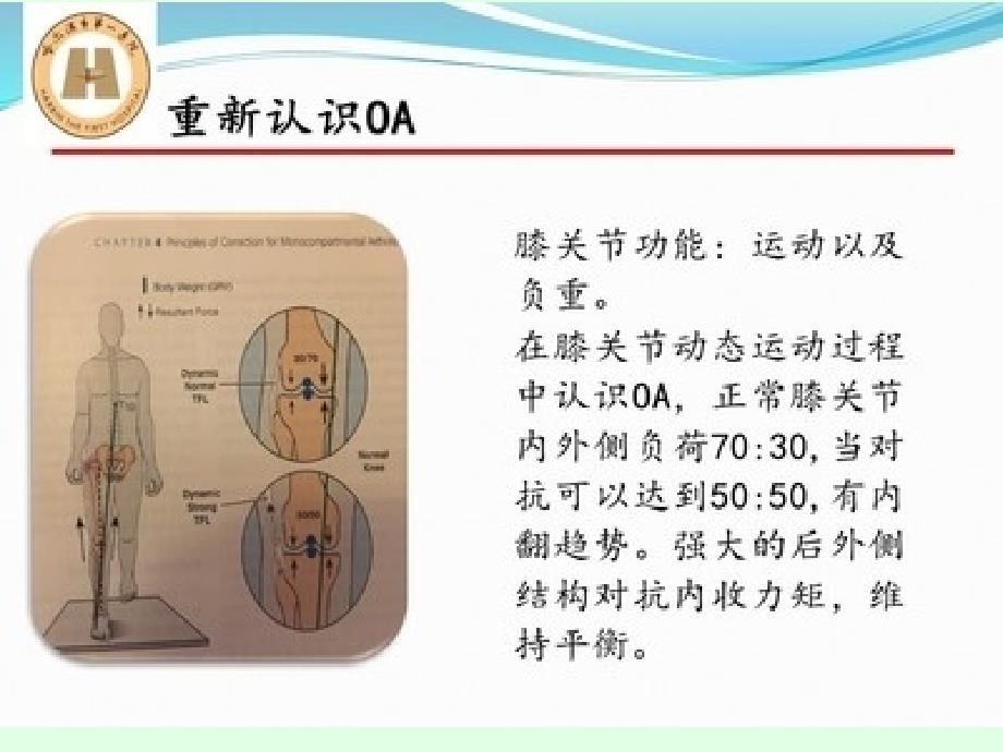 胫骨高位截骨治疗膝关节骨性关节炎课件_第4页