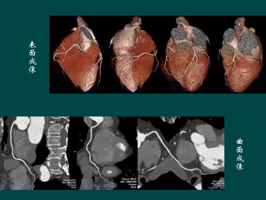 如何看冠脉CTA_第3页