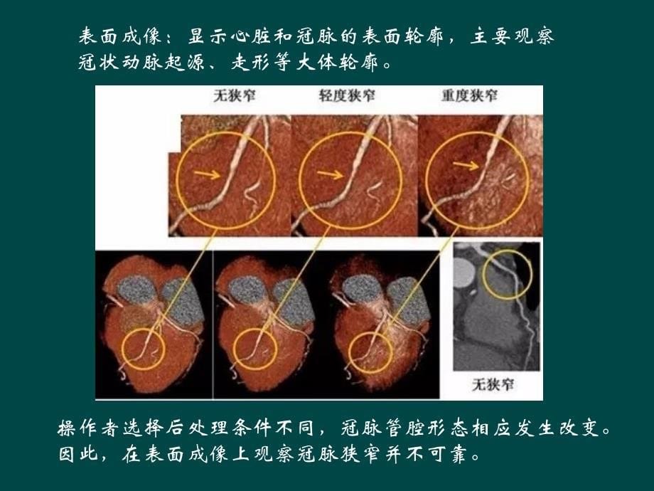 如何看冠脉CTA_第5页