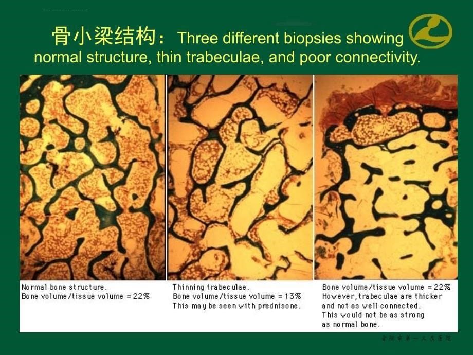 骨质疏松症的实验室检查课件_第5页