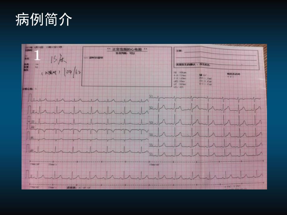 房缺合并左心室憩室一例讲解材料_第3页