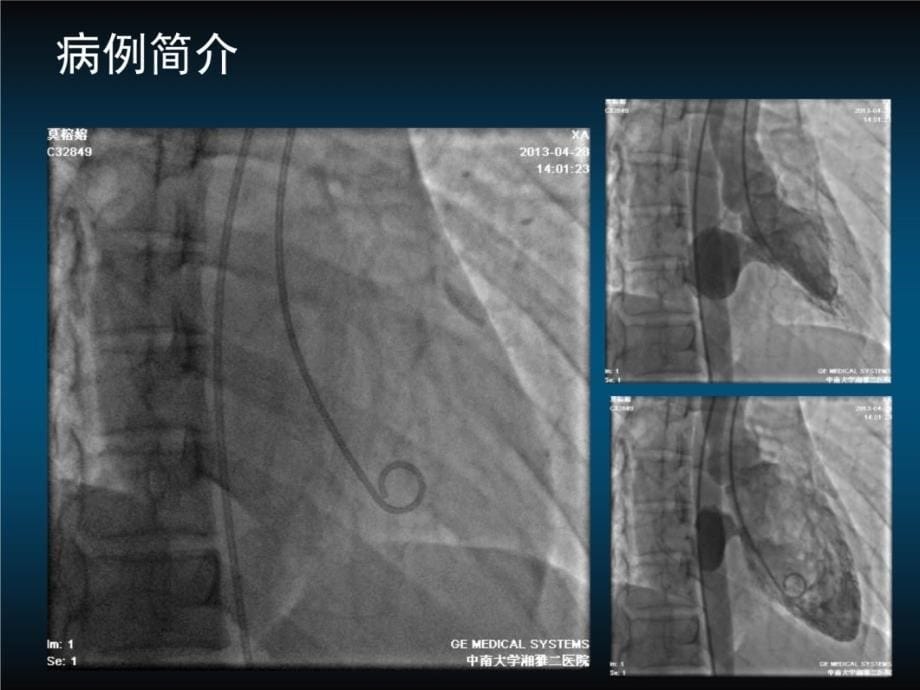 房缺合并左心室憩室一例讲解材料_第5页