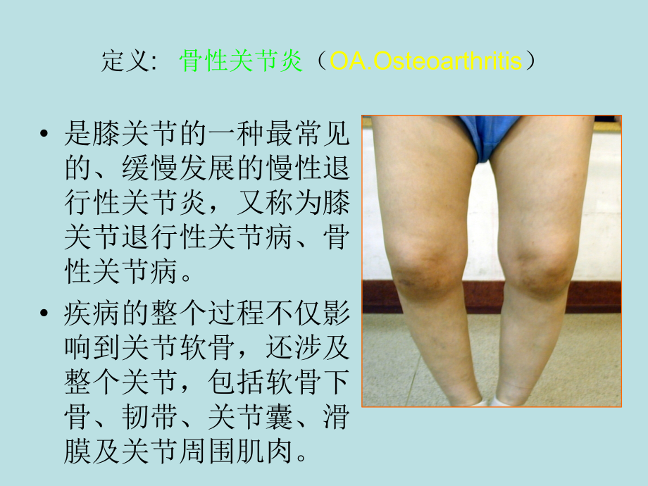 膝关节骨性关节炎诊治课件PPT73619_第2页
