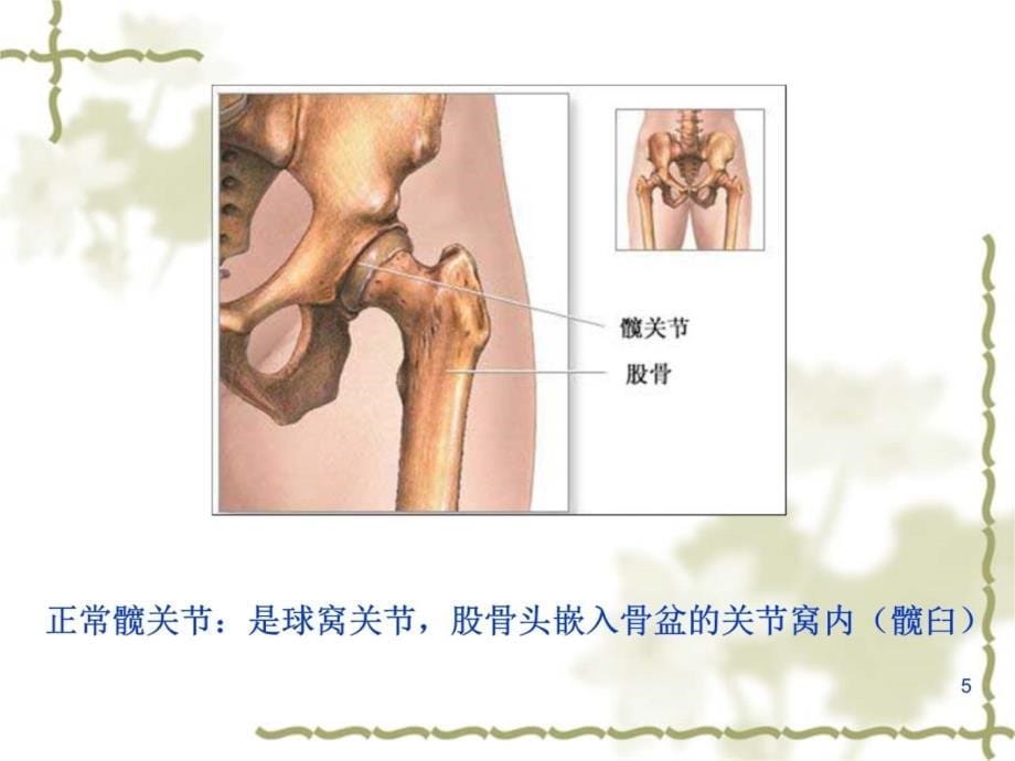 图解髋关节置换术教学讲义_第5页