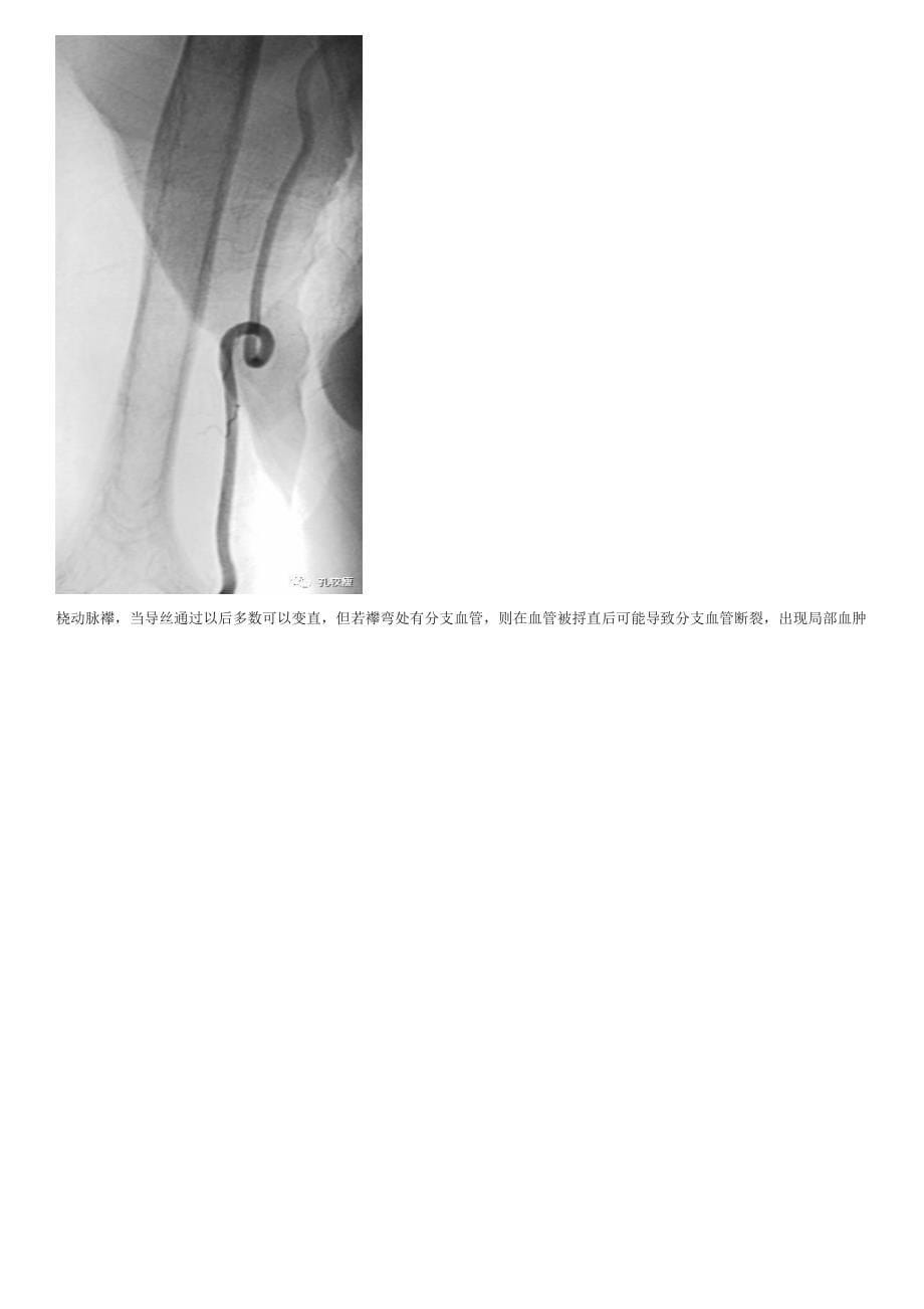 手把手教你桡动脉穿刺技巧(精美图文)_第5页