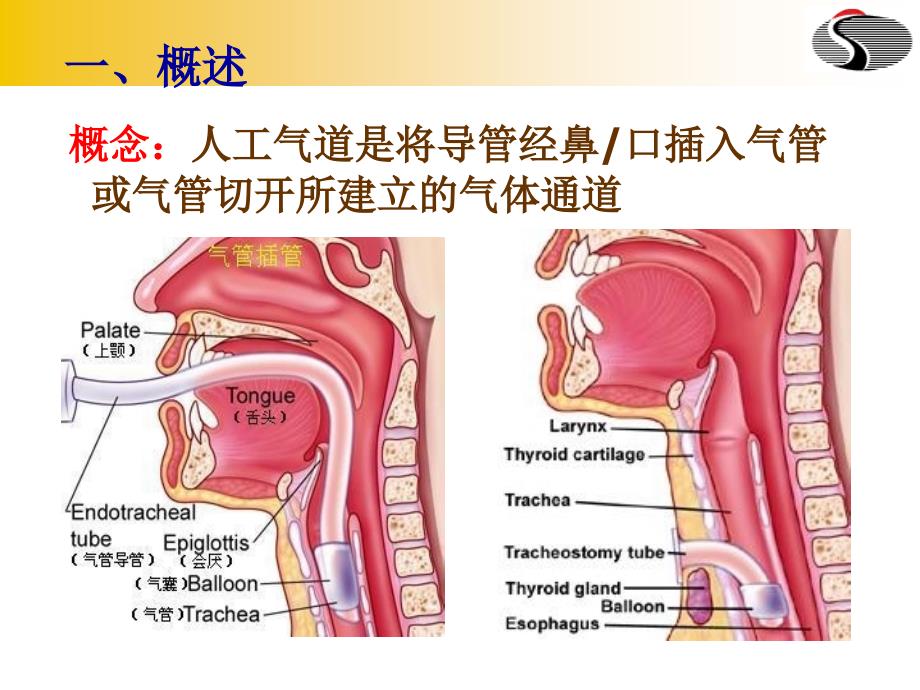 人工气道管理新进展9_第3页