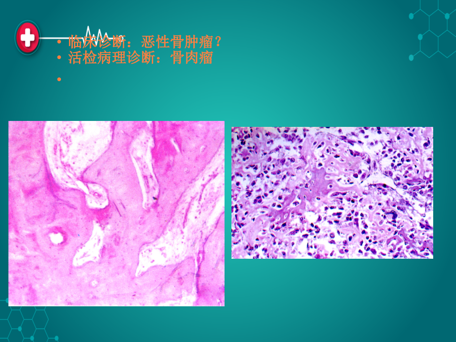 第六章 肿瘤ppt课件_第4页