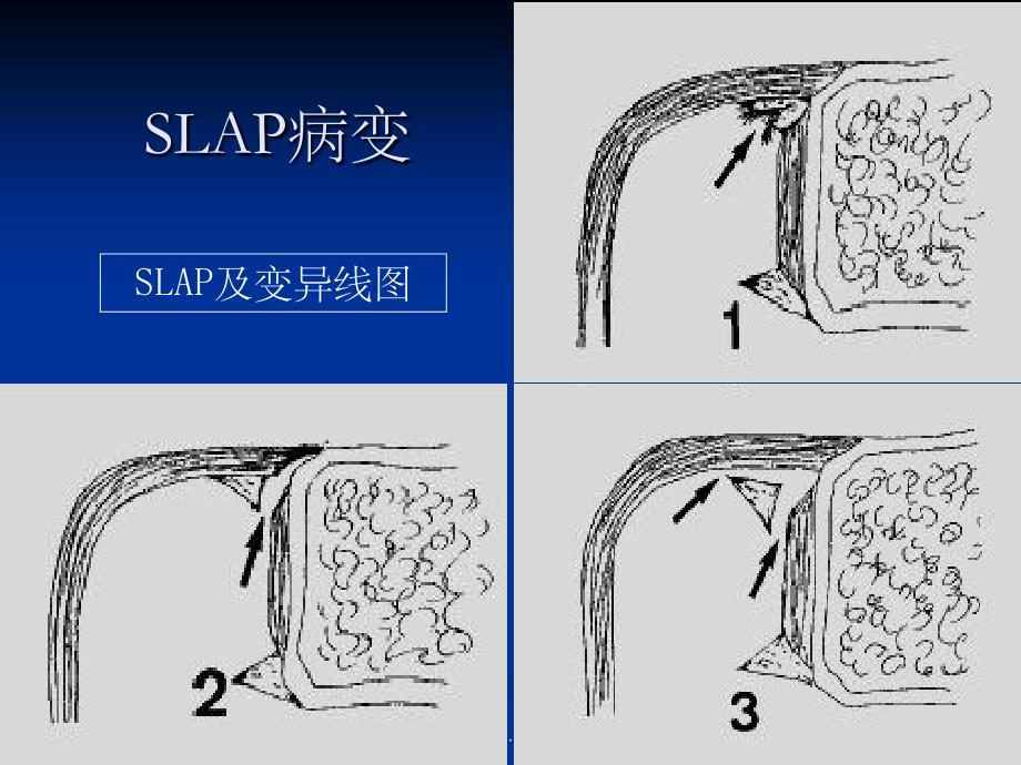 肩关节SLAP损伤的MRI诊断_第4页