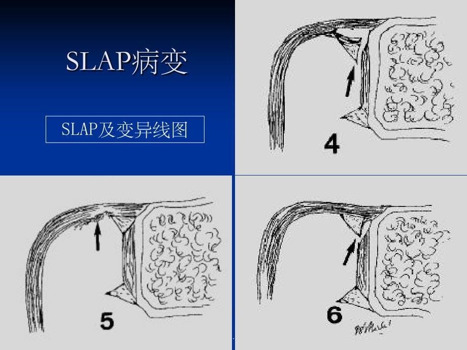 肩关节SLAP损伤的MRI诊断_第5页