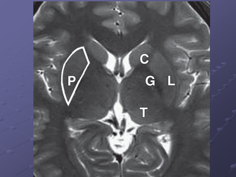 大脑深部对称性灰质核团病变的病因与MRI诊断ppt课件_第4页