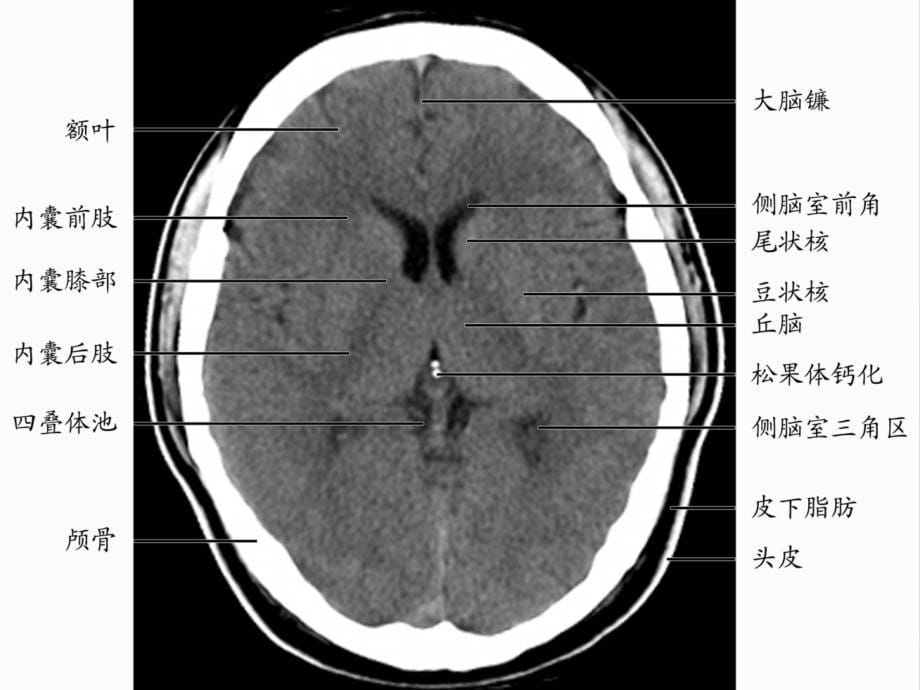 大脑深部对称性灰质核团病变的病因与MRI诊断ppt课件_第5页